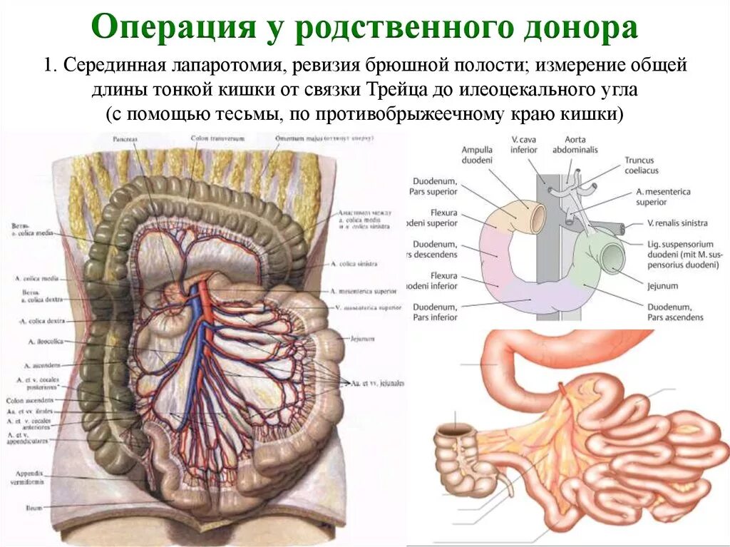 Операция брюшной полости кишечника