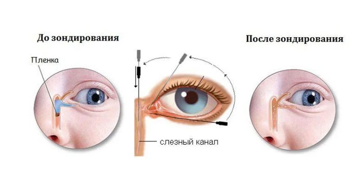 Слезно носовой канал. Непроходимость слезного канала зондирование. Закупорка слезного канала симптомы. Лечение воспаления слезного мешка дакриоцистит. Дакриоцистит массаж слезного канала у новорожденных.