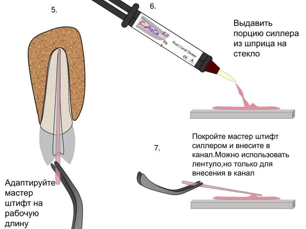 Методы пломбирования корневых. При пломбировании корневого канала используют инструмент. Штифты для корневых каналов классификация. Пломбирование корневого канала зуба со штифтом. Штифты для пломбирования корневых каналов классификация.
