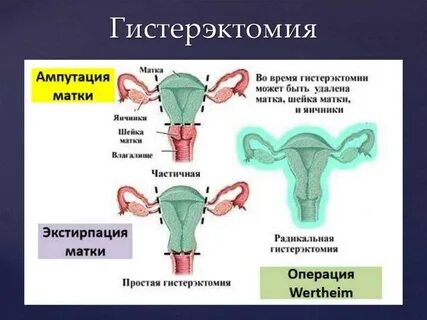 Полное удаление матки