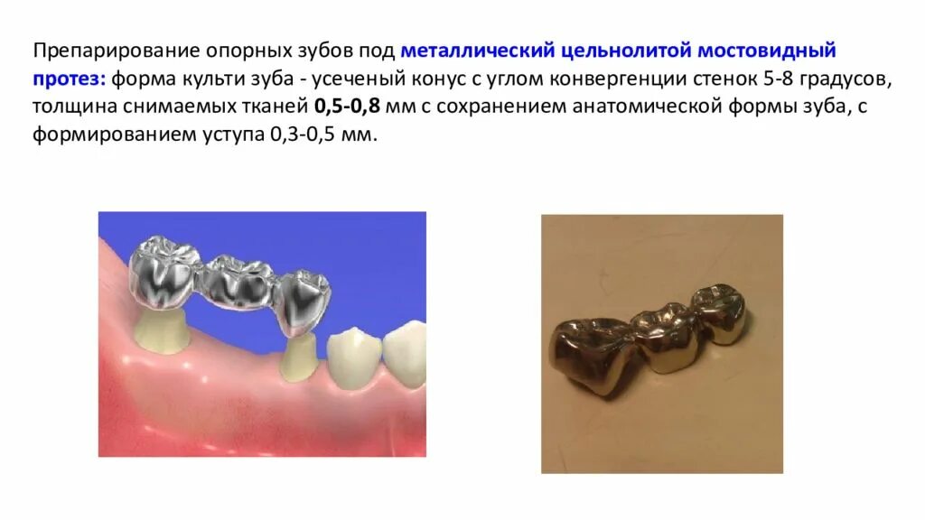 Препарирование под литую. Мостовидный протез опорные зубы. • цельнолитые коронки и мостовидные протезы. цельнолитые коронки препарирование.