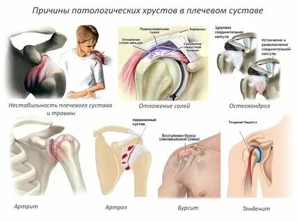 Почему хрустит плечевой сустав