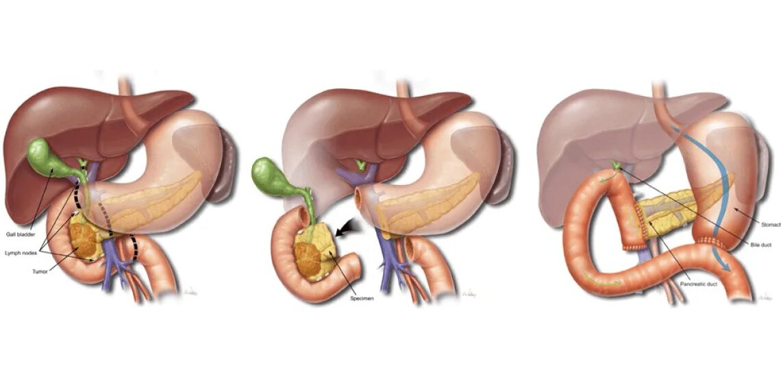 Вода для желчного пузыря. Операция Уиппла на поджелудочной железе. Операция Уиппла (панкреатодуоденальная резекция). Резекция головки поджелудочной железы.