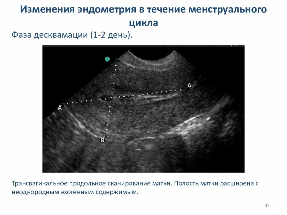 Эндометрий 1 фаза. Десквамация эндометрия УЗИ. УЗИ 2 фазы менструационного цикла. Фаза десквамации эндометрия на УЗИ. Эндометрия матки 2мм.