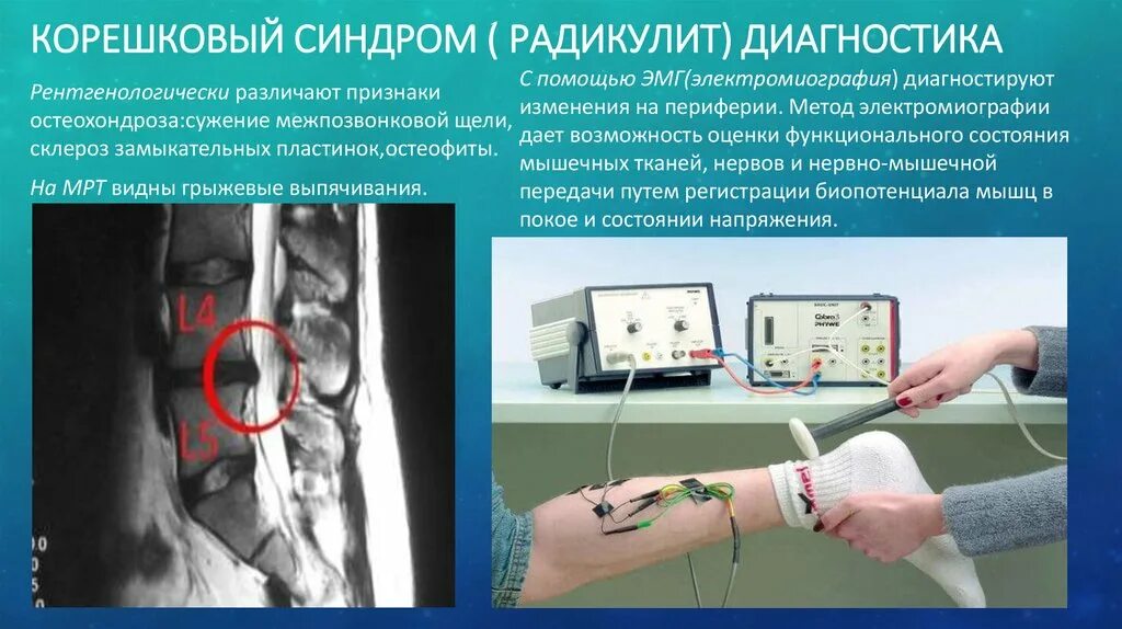 Корешковое поражение. ЭНМГ нижних конечностей. Электронейромиография нижних конечностей. Электромиография нижних конечностей.