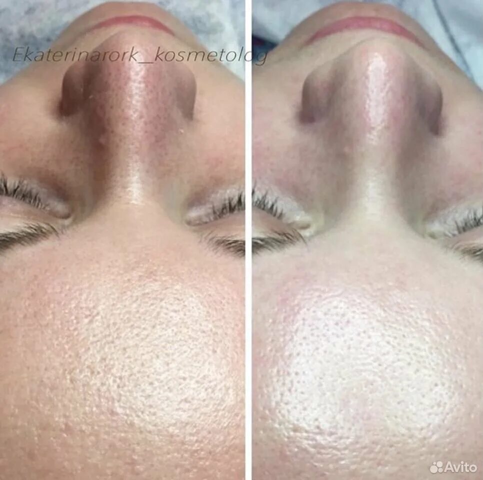 Чистка лица. Лицо после механической чистки. Кожа после механической чистки лица. Комбинированная чистка лица. Кислотный пилинг джеснер.