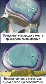 Нуклеопластика межпозвонкового диска