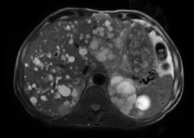 Киста печени мрт. Непаразитарные кисты печени кт.