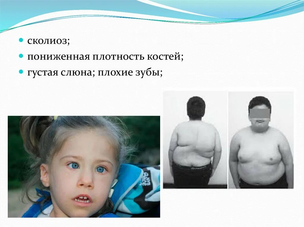 Синдром лоуренса муна барде бидля. Синдром лоуренса муна барде бидля