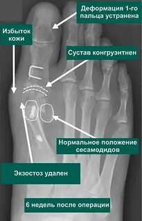 Деформация 1 пальца