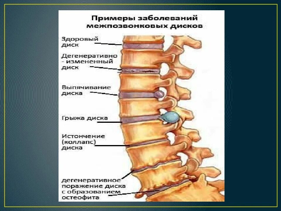 Корешковые нервы в пояснице. Корешковый синдром грудного отдела. Корешок с1 поясничного отдела. Поясничный поясничный остеохондроз. Остеохондроз позвоночника.