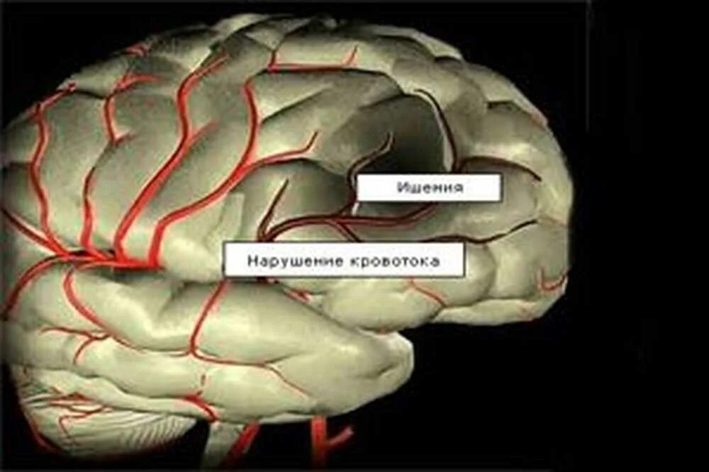 Артерия головного мозга симптомы. Ишемическая болезнь мозга. ишемия головного мозга симптомы. ишемия церебральная хроническая. хроническая ишемия головного мозга 1 степени.