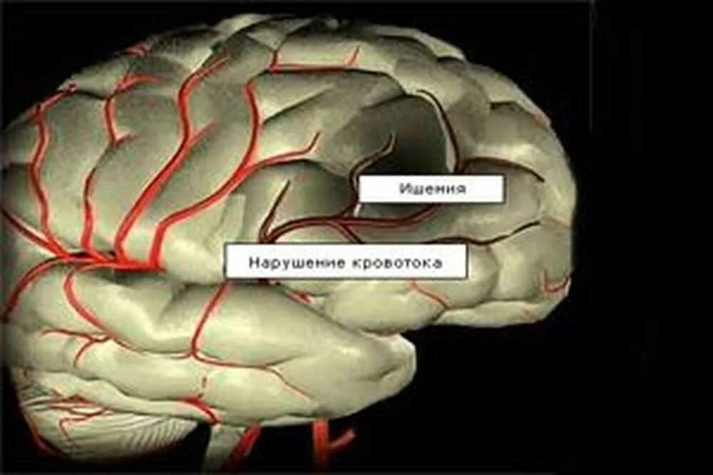 Как лечить ишемию мозга. Ишемическая болезнь мозга. Ишемия сосудов головного мозга. Ишемия головного мозга симптомы. Хроническая ишемия мозга симптомы.