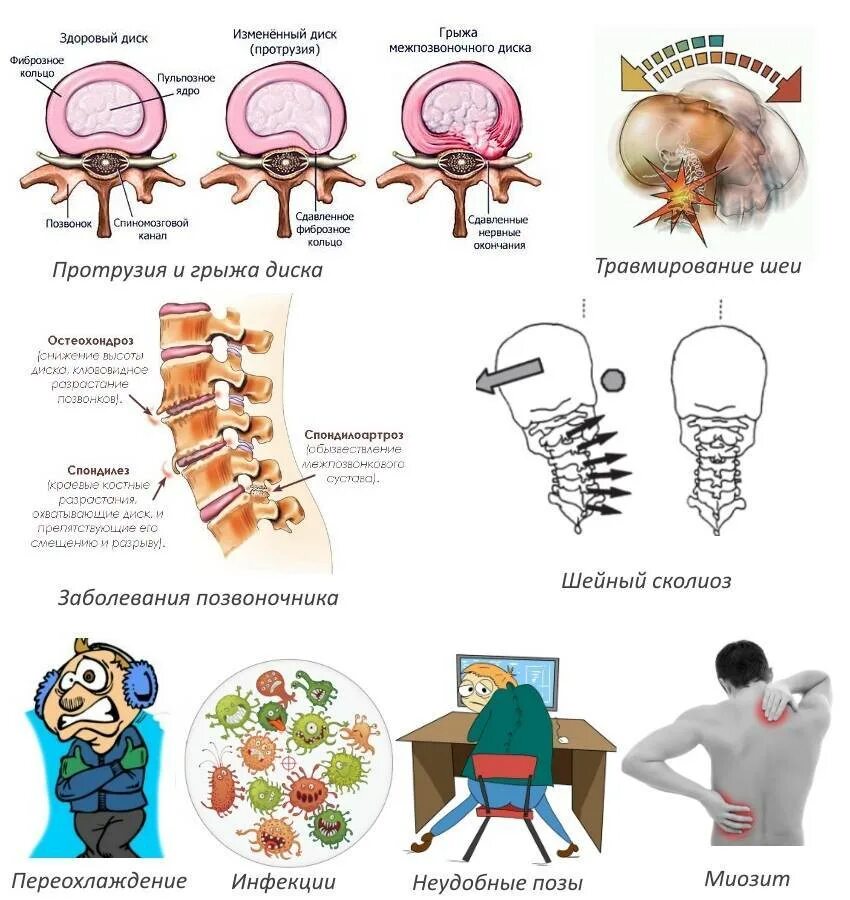 Спондилоартроз шейного отдела позвоночника. Шейный отдел позвоночника з. Остеохондроз шейного отдела симптомы. Синдромы и и клиника шейного остеохондроза.