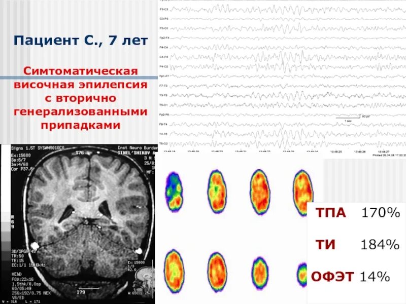 Приступы височной эпилепсии. Височная эпилепсия. лобно-височная эпилепсия. медиальная височная эпилепсия. генерализированный приступ височной эпилепсии.