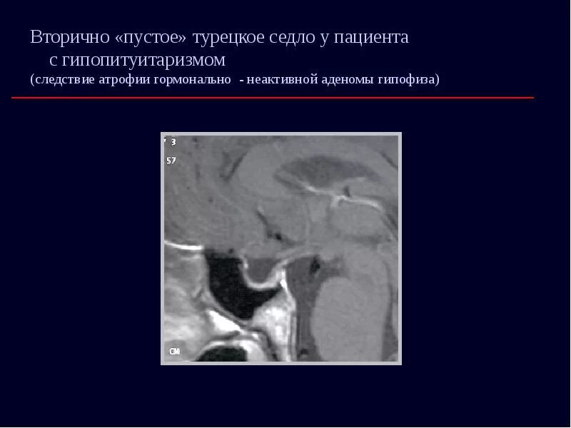 Симптом турецкого седла. Синдром пустого турецкого седла кт. Синдром пустого турецкого седла. Симптом пустого турецкого седла. Патология турецкого седла на рентгене.