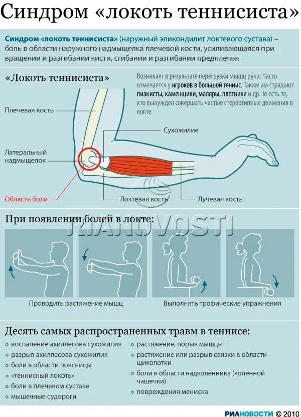 Почему болят руки без причины. Упражнения для эпикондилита локтевого сустава. Заболевание локтевого сустава локоть теннисиста. Локоть теннисиста эпикондилит. При разгибании в локтевом суставе.