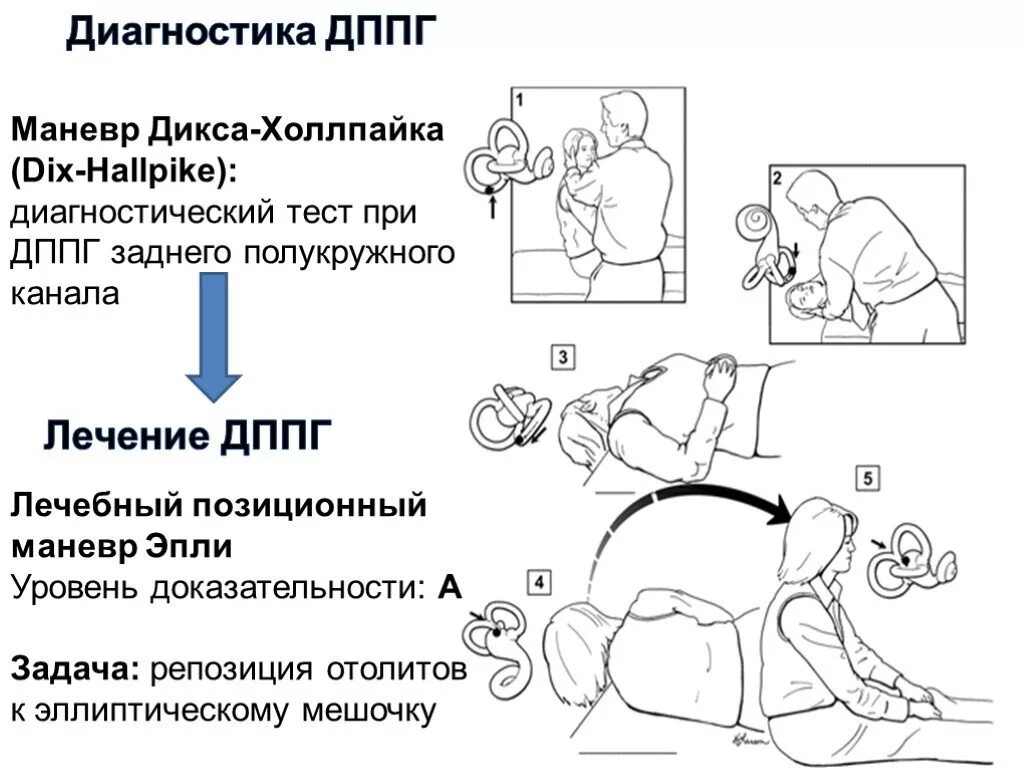 Дппг симптомы. Гимнастика при головокружении дппг. маневры при головокружении дппг. дппг заднего полукружного канала маневры. вестибулярная гимнастика дппг.