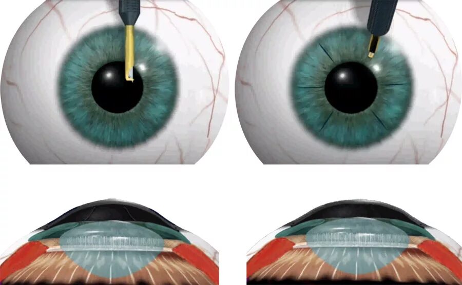 Зрение 2 операция. Радиальная кератотомия при миопии. Операция радиальная кератотомия. Роговичный астигматизм. Кератомия астигматизм.