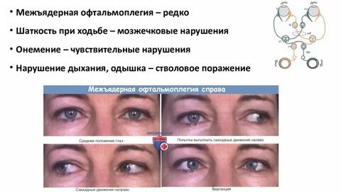 Офтальмоплегия