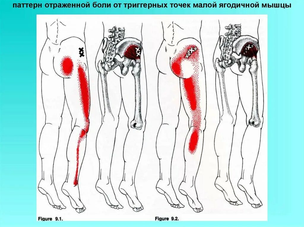 Боль в ягодицах причины у мужчины. Миофасциальный синдром малой ягодичной мышцы. Триггерные точки ягодичной мышцы. Малая ягодичная мышца триггерные точки. Средняя ягодичная мышца триггерные точки.