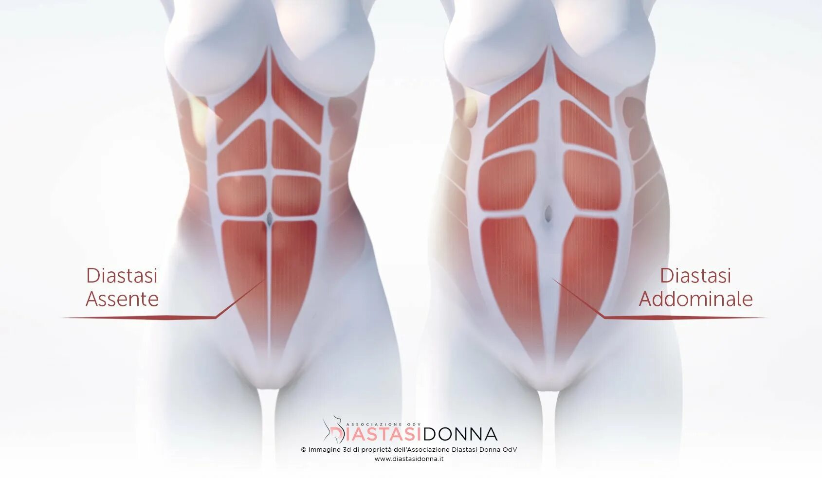 Прямая мышца живота у женщин. Диастаз прямых мышц живота анатомия. Диастаз белой линии живота мкб 10. Прямые мышцы живота диастаз.