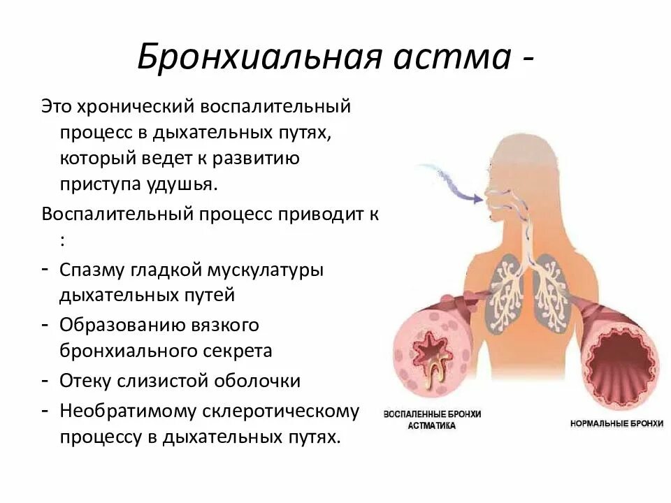 Сколько живут с астмой