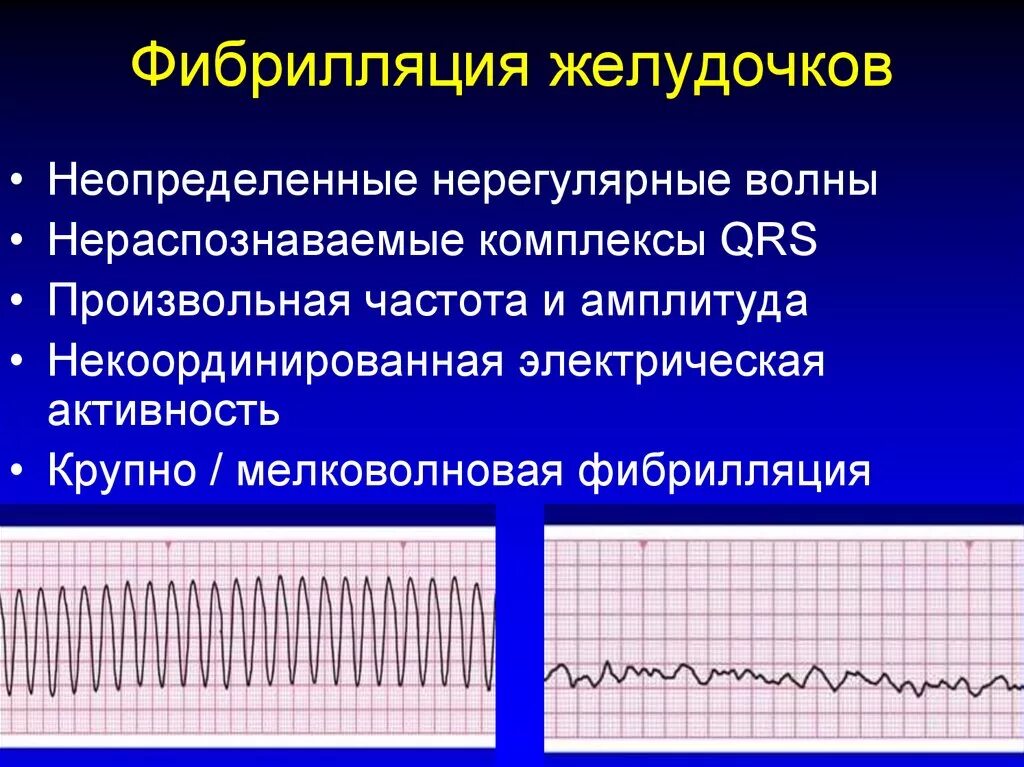 Крупноволновая фибрилляция желудочков на ЭКГ. Фибрилляция желудочков на ЭКГ. Фибрилляция желудочков на ЭКГ признаки. Ритм при фибрилляции желудочков.