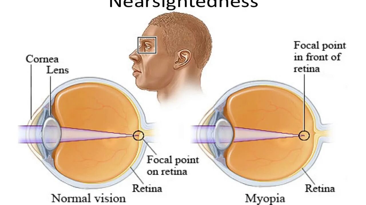 Минус и плюс в зрении. Зрение при близорукости. Близорукость хрусталик. Миопия глаза что это такое. Миопия хрусталик.