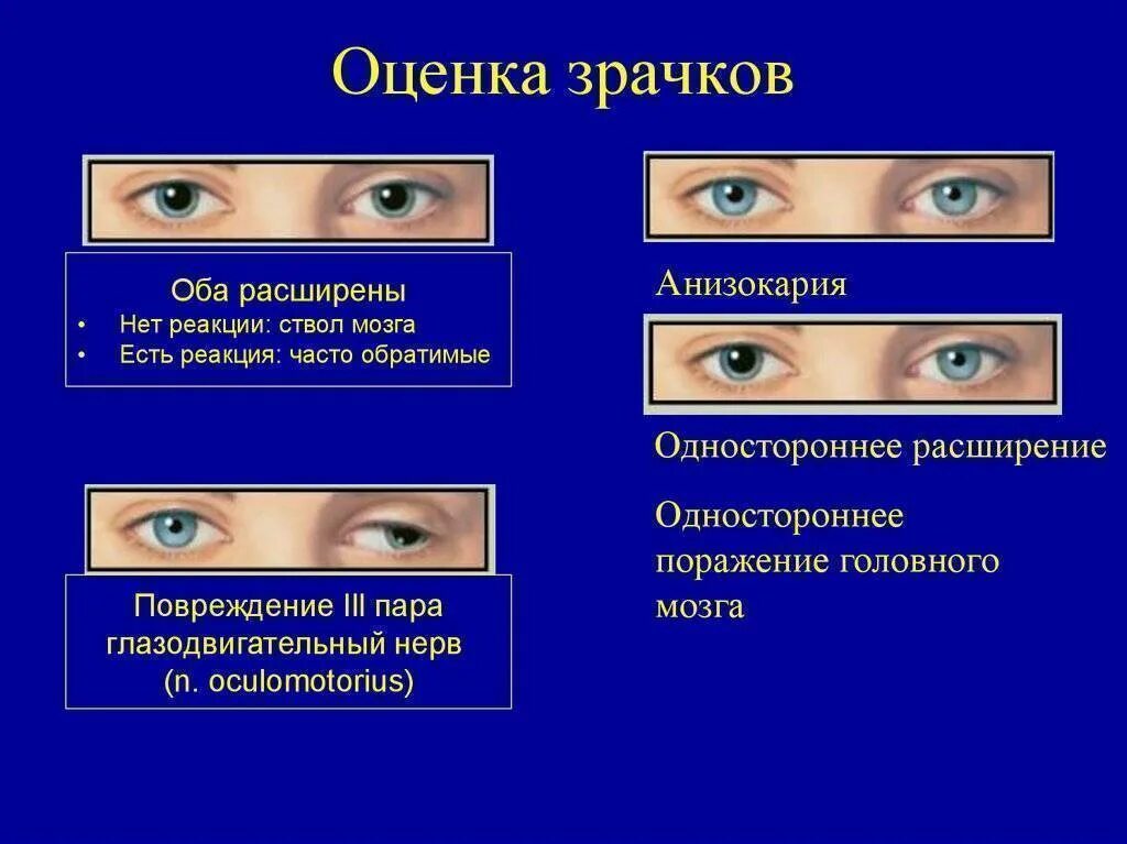 Почему зрачок сужается и расширяется. Нормальный зрачок и расширенный. реакция зрачков на свет. зрачки человека в нормальном состоянии. нормальный размер зрачков.