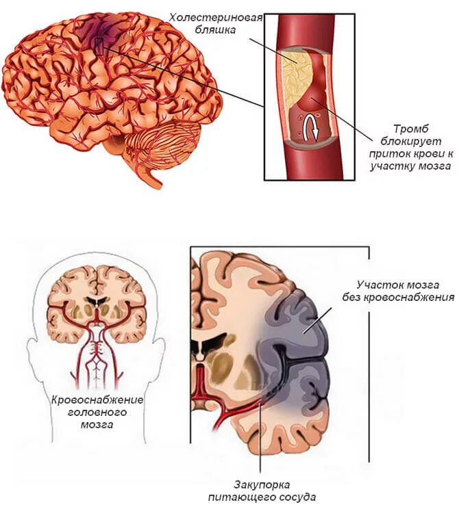 Ишемический инсульт патанатомия препарат. Причины развития ишемического инфаркта головного мозга. Ишемический инфаркт головного мозга причины. Ишемический инсульт (инфаркт мозга).