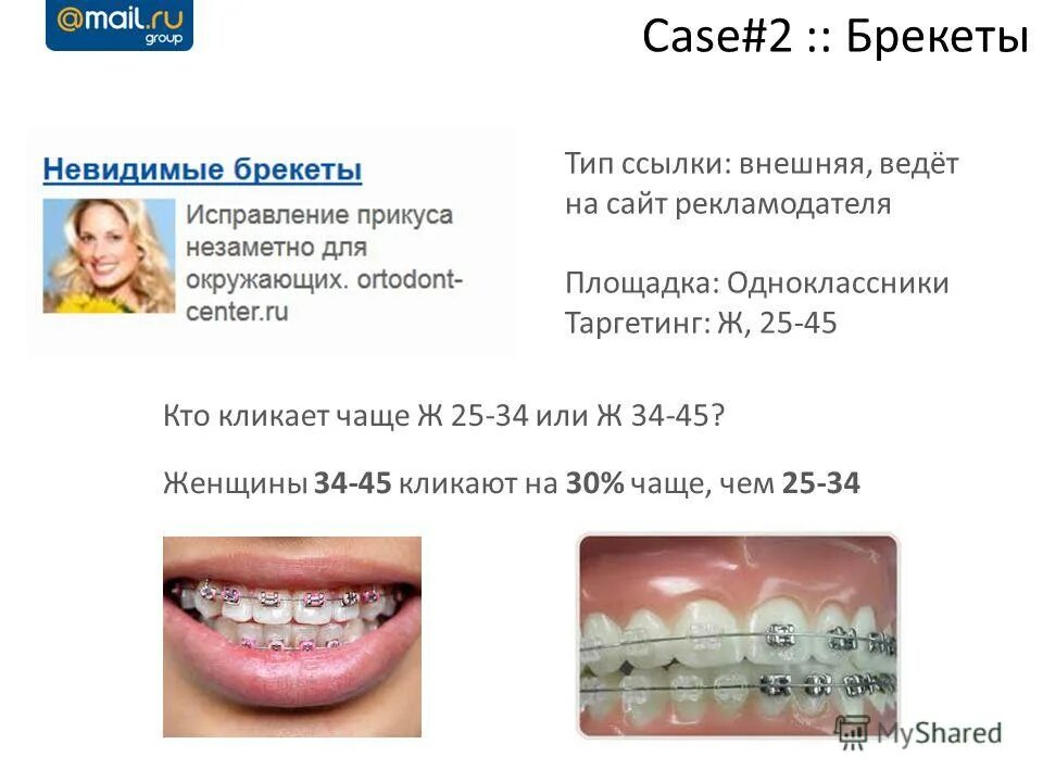 безлигатурные брекеты резиночки. эстетика в стоматологии функциональная. брекеты металлические безлигатурные slx dynaflex.