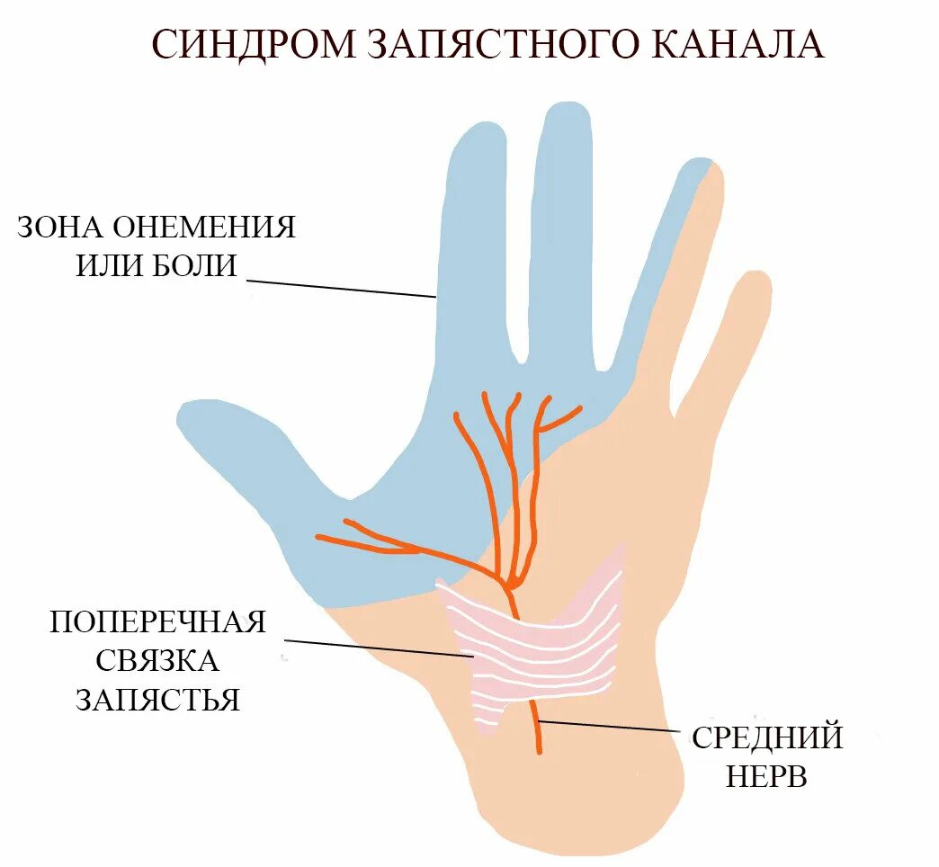 Туннельный синдром запястья кисти. Карпальный туннельный синдром кисти. Туннельный синдром запястья упражнения. Туннельный карпальный синдром руки. Туннельный синдром после операции