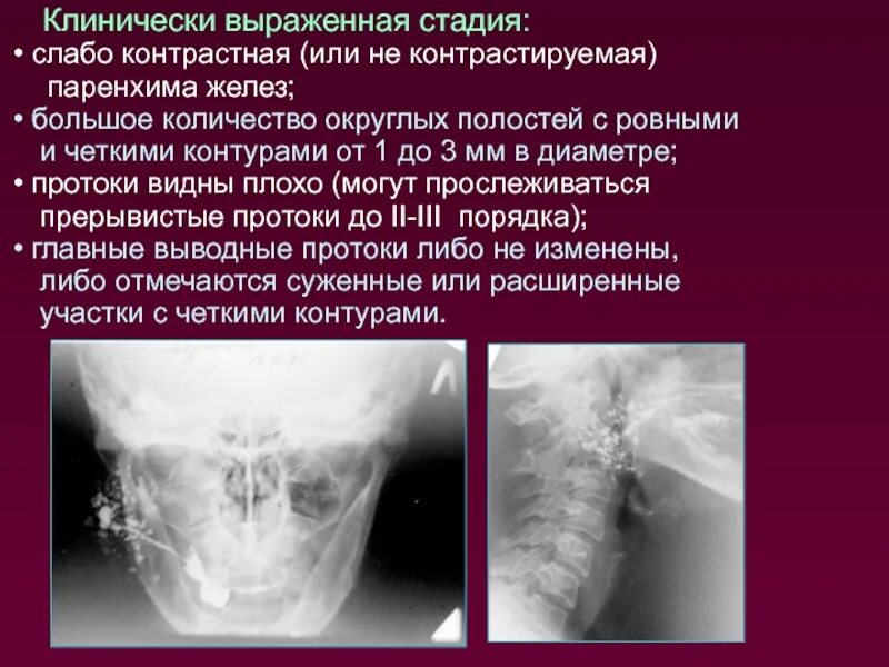 Выраженная стадия