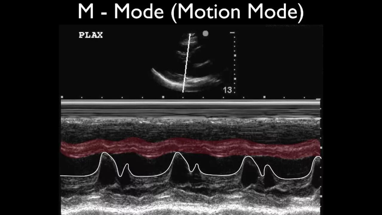 M mode. M-mode ultrasound. ultrasound a b m mode. systolic anterior motion m-mode. ultrasound medical a-mode.