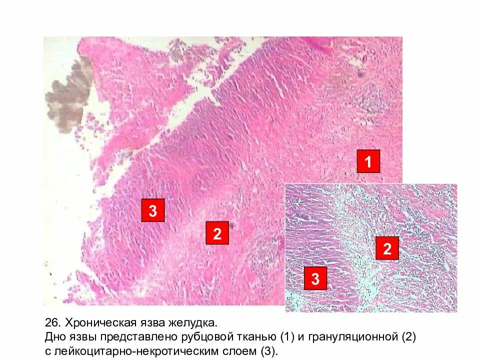 Язва микропрепарат