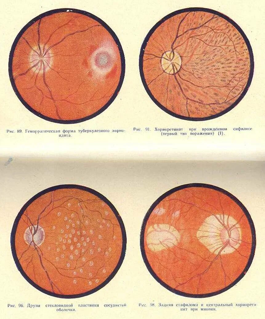 Заболевания сосудистой оболочки. Патология сосудистой оболочки. Туберкулезное поражение сетчатки.