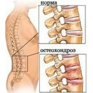 Сорвал спину