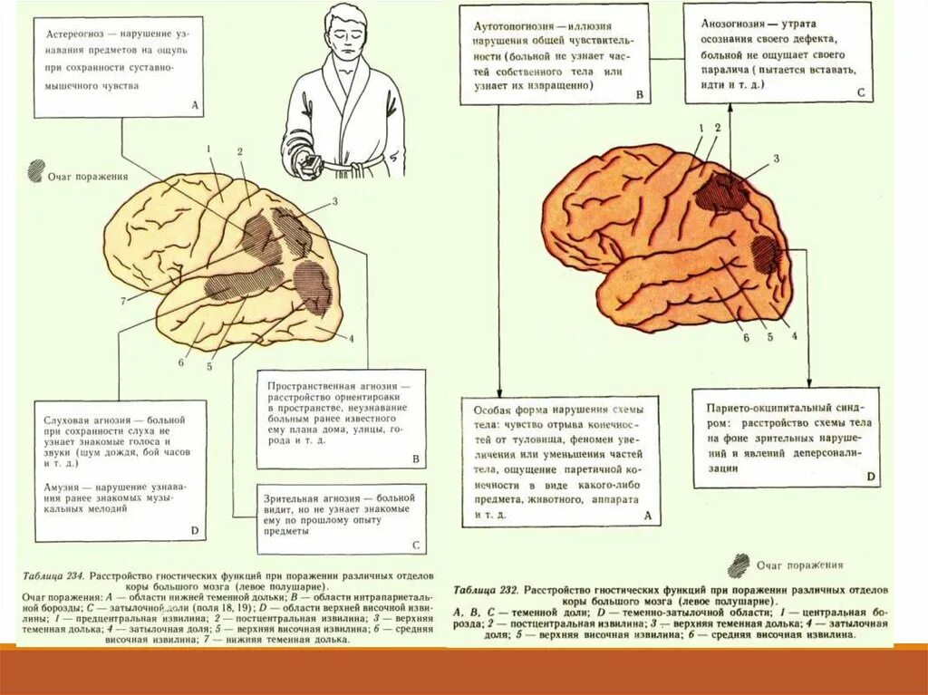 Поражения корково мозга. Агнозия возникает при поражении коры головного мозга. Тактильная агнозия локализация поражения. Зрительная агнозия возникает при поражении. Зрительная агнозия очаг поражения.