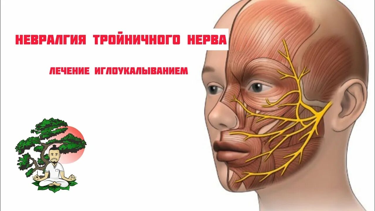 Почему воспаляется нерв. Воспаление троичногонерва. Воспаление тройничного нерва. Воспаление тройничного нерва на лице.