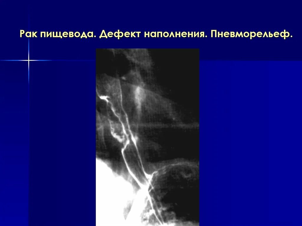 Дефект наполнения пищевода. Опухоль пищевода рентген. карцинома пищевода рентген. лейомиома пищевода рентген. утолщение складок пищевода рентген.
