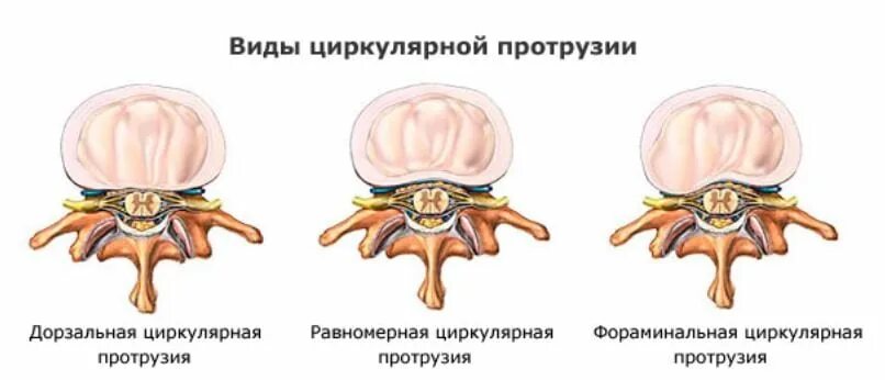 Диффузная протрузия межпозвонковых. Циркулярная протрузия межпозвонкового диска l3-l4. дорзальная диффузная протрузия межпозвонкового диска l5-s1. циркулярная протрузия дисков l4-l5. циркулярные протрузии межпозвонковых дисков l4-l5 что это.