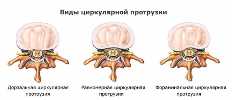 Циркулярная протрузия межпозвонкового диска l3-l4. Дорзальная диффузная протрузия межпозвонкового диска l5-s1. Циркулярная протрузия дисков l4-l5. Циркулярные протрузии межпозвонковых дисков l4-l5 что это.