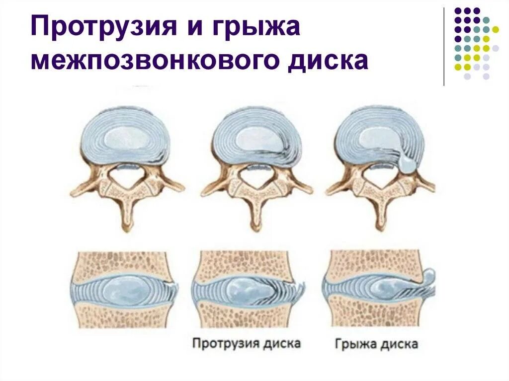 Протрузия межпозвоночного диска поясничного. Межпозвоночный диск протрузия грыжа. Протрузия дисков позвоночника что это такое. Протрузия и грыжа позвоночника отличие. Протрузия экструзия грыжа.