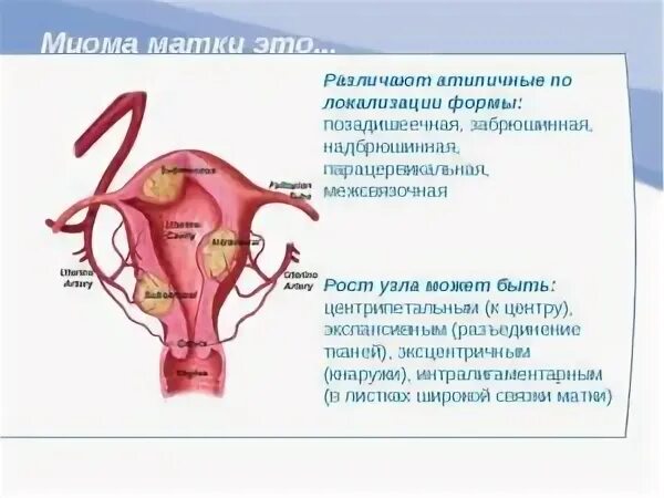Миома эндометрия