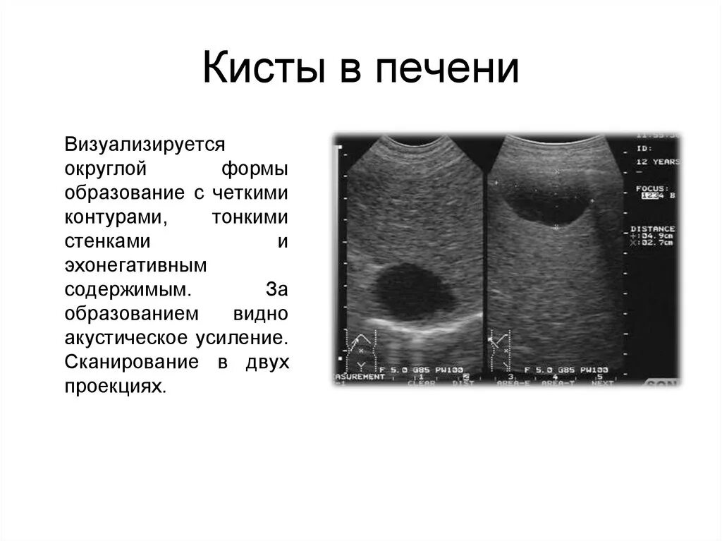 Чем лечить кисту левой доли печени. Кистозные образования печени УЗИ. Многокамерная киста печени.