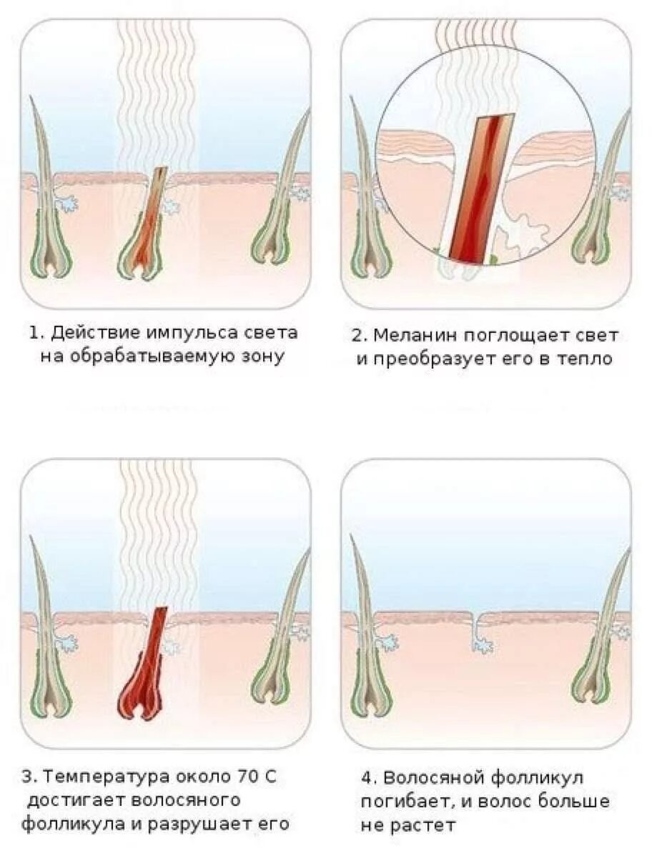 Как происходит лазерная