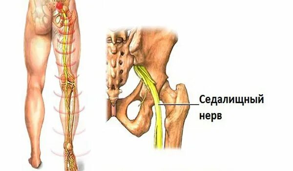 Защемление седалищного нерва. Ишиас седалищного нерва. Защемило седалищный нерв. Седалищный нерв расположен. Седалищный нерв в пояснице