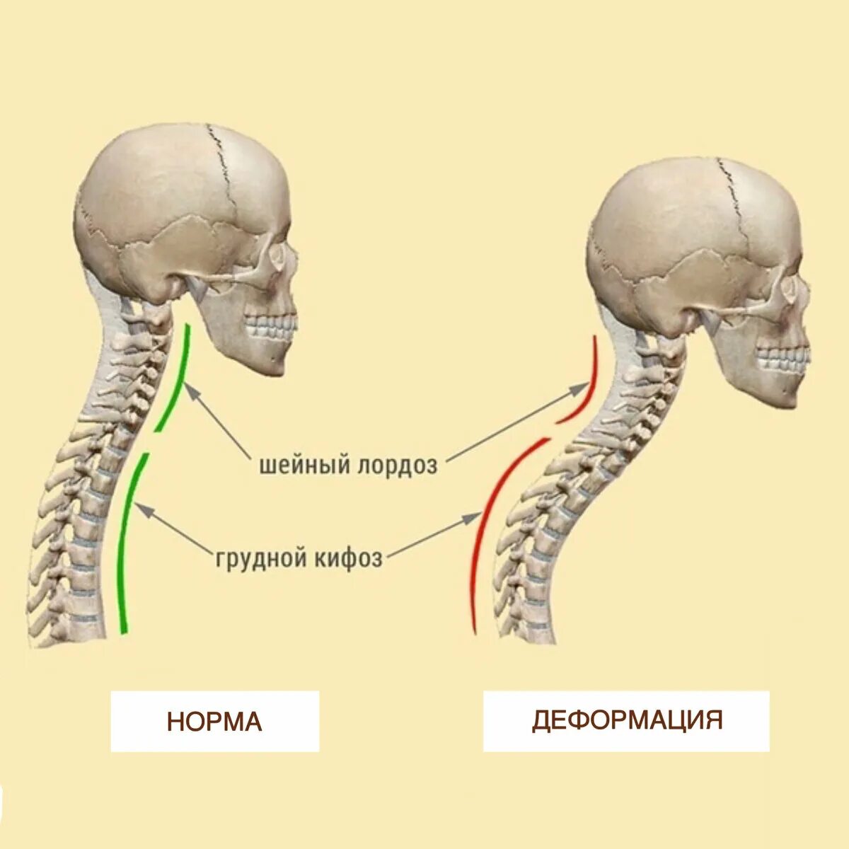 Лордоз шейного отдела позвоночника. Кифоз и лордоз шейного отдела. Выпрямленный лордоз шейного отдела позвоночника. Гиперлордоз шейного отдела. Прямой позвоночник без изгибов