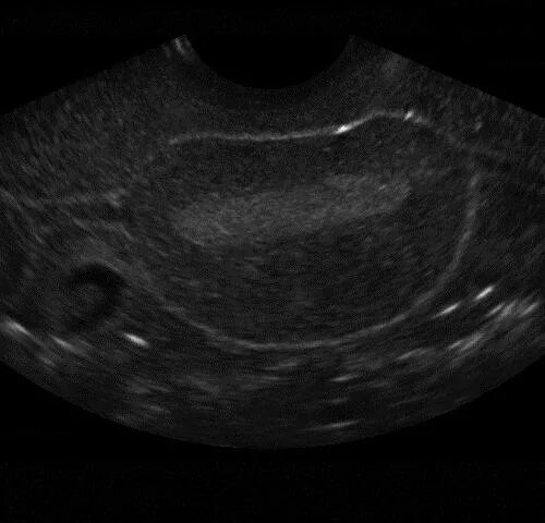 Внематочная беременность на УЗИ. Внематочная беременность 3 недели. Трубная беременность УЗИ. УЗИ внематочной беременности на раннем сроке.